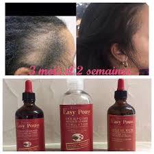 EASY POUSS - Anti-Hair Loss Treatment. Healthy Hair Growth - ShanShar